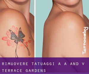 Rimuovere Tatuaggi a A and V Terrace Gardens