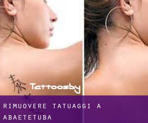 Rimuovere Tatuaggi a Abaetetuba