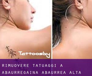 Rimuovere Tatuaggi a Abaurregaina / Abaurrea Alta