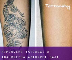 Rimuovere Tatuaggi a Abaurrepea / Abaurrea Baja