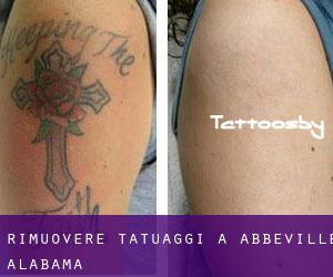 Rimuovere Tatuaggi a Abbeville (Alabama)