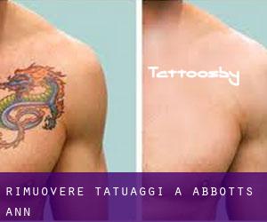 Rimuovere Tatuaggi a Abbotts Ann