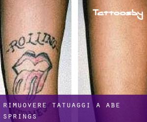 Rimuovere Tatuaggi a Abe Springs