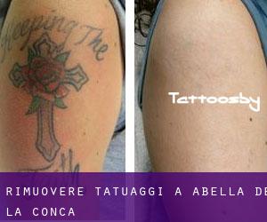 Rimuovere Tatuaggi a Abella de la Conca