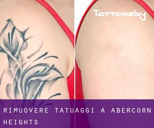 Rimuovere Tatuaggi a Abercorn Heights