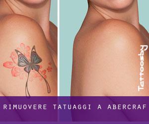 Rimuovere Tatuaggi a Abercraf