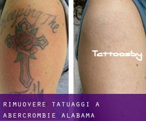 Rimuovere Tatuaggi a Abercrombie (Alabama)