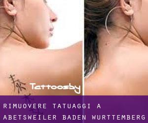 Rimuovere Tatuaggi a Abetsweiler (Baden-Württemberg)