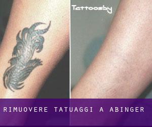 Rimuovere Tatuaggi a Abinger