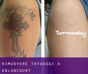 Rimuovere Tatuaggi a Ablancourt