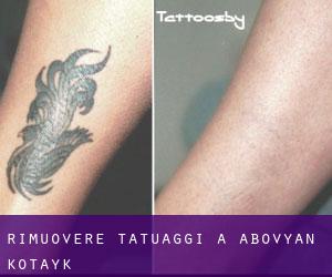 Rimuovere Tatuaggi a Abovyan (Kotaykʼ)