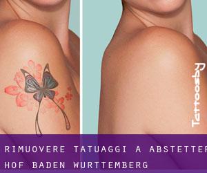 Rimuovere Tatuaggi a Abstetter Hof (Baden-Württemberg)
