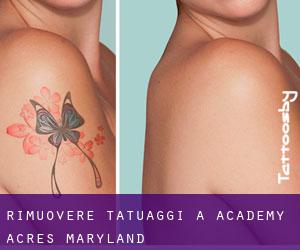 Rimuovere Tatuaggi a Academy Acres (Maryland)