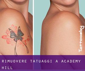 Rimuovere Tatuaggi a Academy Hill