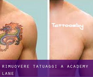 Rimuovere Tatuaggi a Academy Lane