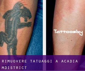 Rimuovere Tatuaggi a Acadia M.District