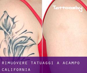 Rimuovere Tatuaggi a Acampo (California)