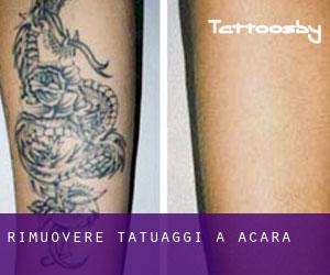 Rimuovere Tatuaggi a Acará