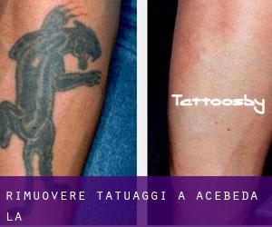 Rimuovere Tatuaggi a Acebeda (La)