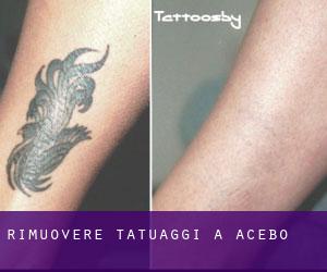 Rimuovere Tatuaggi a Acebo