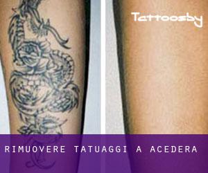 Rimuovere Tatuaggi a Acedera
