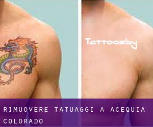 Rimuovere Tatuaggi a Acequia (Colorado)