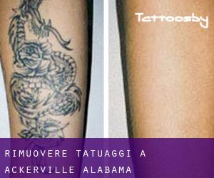 Rimuovere Tatuaggi a Ackerville (Alabama)
