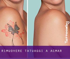 Rimuovere Tatuaggi a Acmar