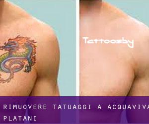 Rimuovere Tatuaggi a Acquaviva Platani