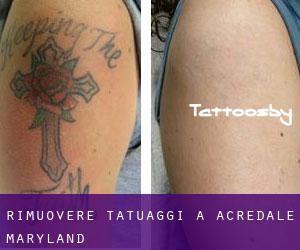 Rimuovere Tatuaggi a Acredale (Maryland)