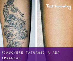 Rimuovere Tatuaggi a Ada (Arkansas)