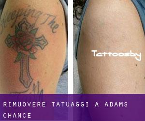 Rimuovere Tatuaggi a Adams Chance
