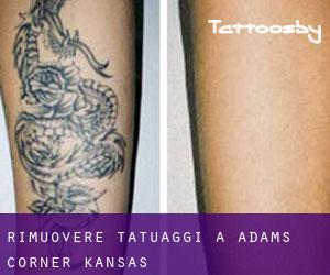 Rimuovere Tatuaggi a Adams Corner (Kansas)