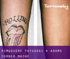 Rimuovere Tatuaggi a Adams Corner (Maine)