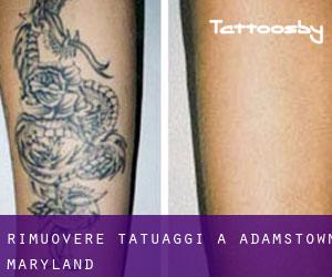 Rimuovere Tatuaggi a Adamstown (Maryland)