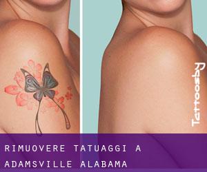 Rimuovere Tatuaggi a Adamsville (Alabama)