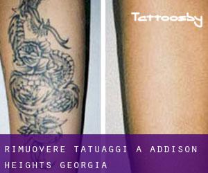 Rimuovere Tatuaggi a Addison Heights (Georgia)