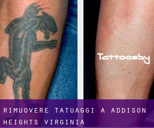 Rimuovere Tatuaggi a Addison Heights (Virginia)