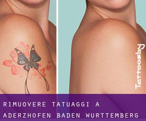 Rimuovere Tatuaggi a Aderzhofen (Baden-Württemberg)