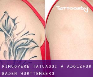 Rimuovere Tatuaggi a Adolzfurt (Baden-Württemberg)