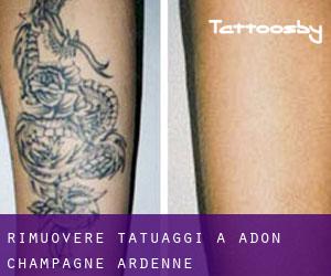 Rimuovere Tatuaggi a Adon (Champagne-Ardenne)