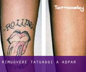 Rimuovere Tatuaggi a Adpar