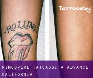 Rimuovere Tatuaggi a Advance (California)