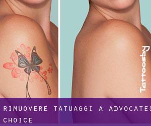 Rimuovere Tatuaggi a Advocates Choice