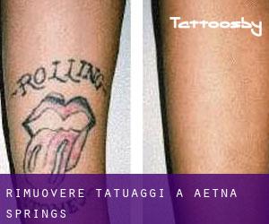 Rimuovere Tatuaggi a Aetna Springs