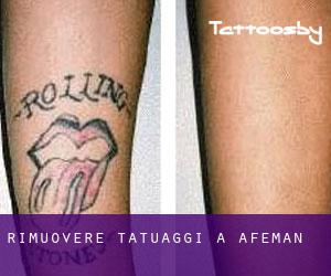Rimuovere Tatuaggi a Afeman