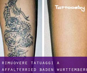 Rimuovere Tatuaggi a Affalterried (Baden-Württemberg)