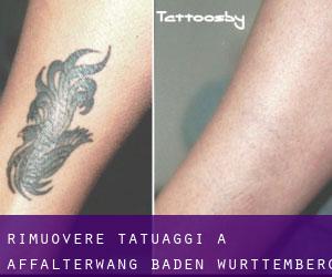 Rimuovere Tatuaggi a Affalterwang (Baden-Württemberg)