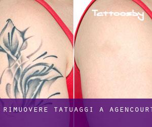 Rimuovere Tatuaggi a Agencourt
