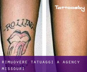 Rimuovere Tatuaggi a Agency (Missouri)